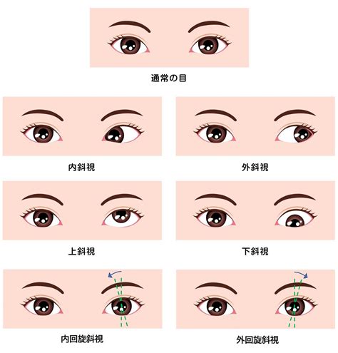 眼睛斜視|斜視：成因、病徵及治療